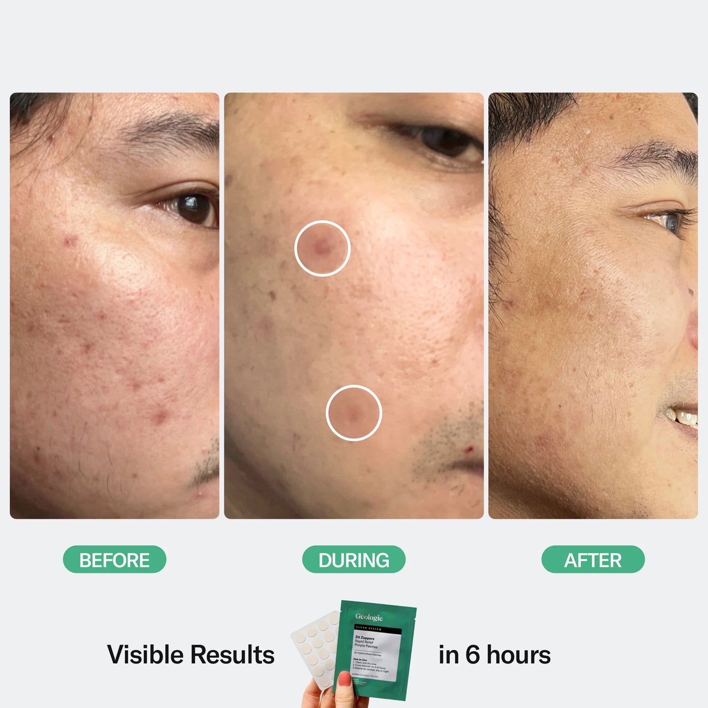 Zit Zapper Pimple Patches