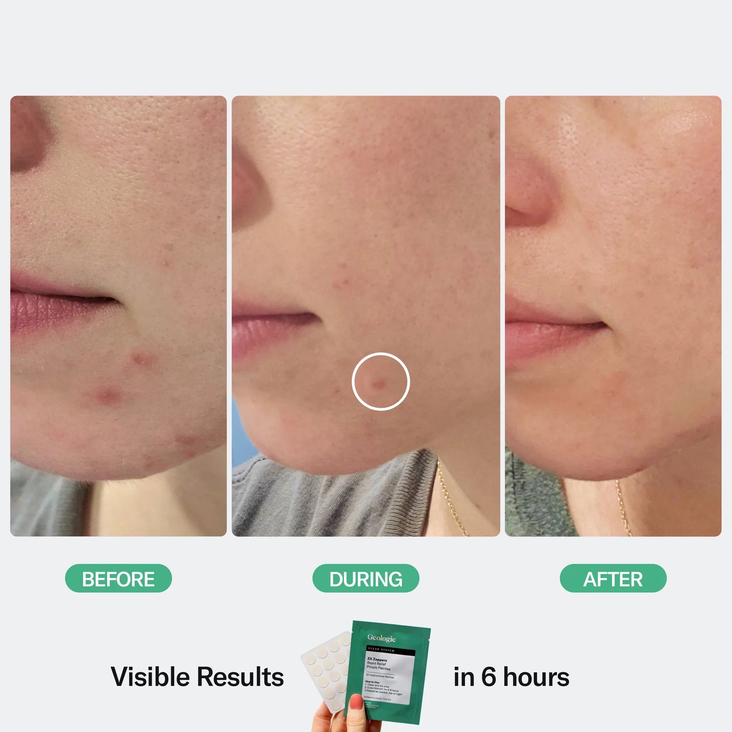 Zit Zapper Pimple Patches